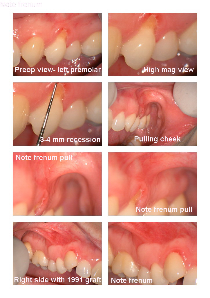 Grafting and frenums edited.jpg